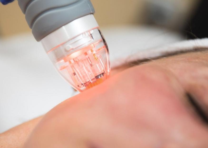 advanced-rf-microneedling-spokane-wa-near-me